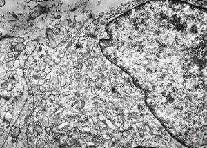 F,81y. | liposarcoma